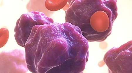 mrd-aml-blog-feature-hmd-webinar